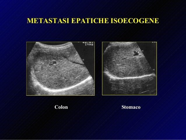 Fegato Lesioni Focali