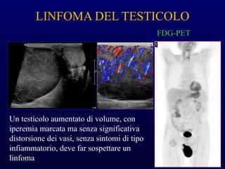 Un testicolo aumentato di volume, con
iperemia marcata ma senza significativa
distorsione dei vasi, senza sintomi di tipo
infiammatorio, deve far sospettare un
linfoma
FDG-PET
LINFOMA DEL TESTICOLO
 