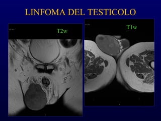 LINFOMA DEL TESTICOLO
T2w
T1w
 