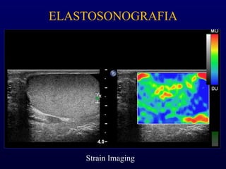 ELASTOSONOGRAFIA
Strain Imaging
 