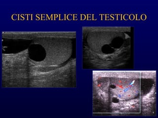 CISTI SEMPLICE DEL TESTICOLO
 