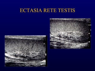 ECTASIA RETE TESTIS
 