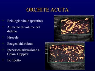 ORCHITE ACUTA
• Eziologia virale (parotite)
• Aumento di volume del
didimo
• Idrocele
• Ecogenicità ridotta
• Ipervascolarizzazione al
Color- Doppler
• IR ridotto
 