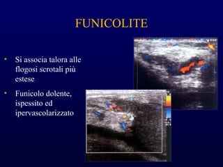 FUNICOLITE
• Si associa talora alle
flogosi scrotali più
estese
• Funicolo dolente,
ispessito ed
ipervascolarizzato
 