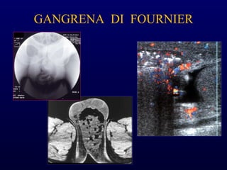 GANGRENA DI FOURNIER
 