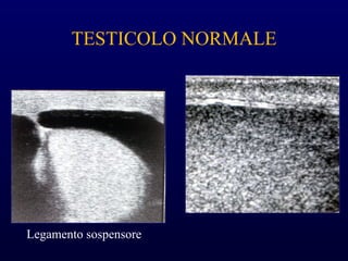 TESTICOLO NORMALE
Legamento sospensore
 