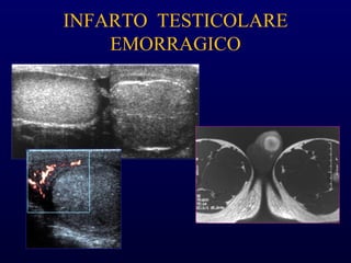 INFARTO TESTICOLARE
EMORRAGICO
 