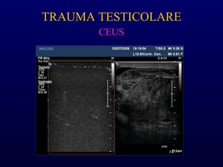 TRAUMA TESTICOLARE
CEUS
 