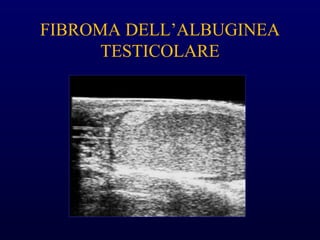 FIBROMA DELL’ALBUGINEA
TESTICOLARE
 