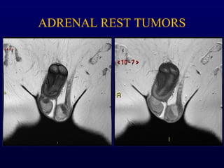 ADRENAL REST TUMORS
 