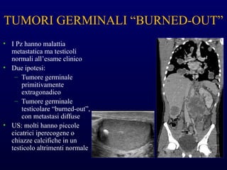 TUMORI GERMINALI “BURNED-OUT”
• I Pz hanno malattia
metastatica ma testicoli
normali all’esame clinico
• Due ipotesi:
– Tumore germinale
primitivamente
extragonadico
– Tumore germinale
testicolare “burned-out”,
con metastasi diffuse
• US: molti hanno piccole
cicatrici iperecogene o
chiazze calcifiche in un
testicolo altrimenti normale
 