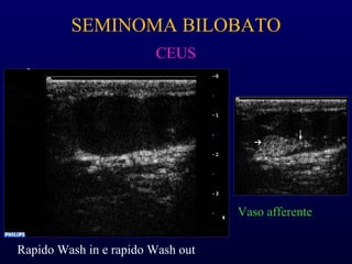 CEUS
SEMINOMA BILOBATO
Vaso afferente
Rapido Wash in e rapido Wash out
 