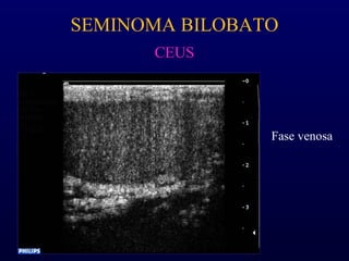 Fase venosa
SEMINOMA BILOBATO
CEUS
 