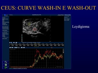 CEUS: CURVE WASH-IN E WASH-OUT
Leydigioma
 