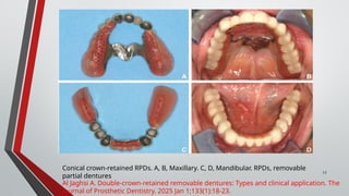 Mandiblar Rpd Double-Crown-Retained Removable Dentures: Types, Techniques, and ...