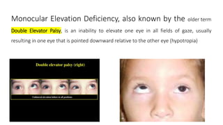 Monocular Elevation Deficiency, also known by the older term
Double Elevator Palsy, is an inability to elevate one eye in all fields of gaze, usually
resulting in one eye that is pointed downward relative to the other eye (hypotropia)
 