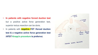 • In patients with negative forced duction test
but a positive active force generation test,
superior rectus resection can be done.
• In patients with negative FDT /forced duction
test & a negative active force generation test
/ATGT Knapp's procedure is preferred.
 