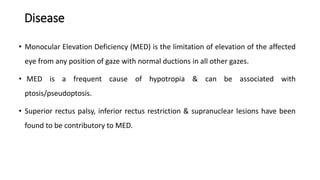 Disease
• Monocular Elevation Deficiency (MED) is the limitation of elevation of the affected
eye from any position of gaze with normal ductions in all other gazes.
• MED is a frequent cause of hypotropia & can be associated with
ptosis/pseudoptosis.
• Superior rectus palsy, inferior rectus restriction & supranuclear lesions have been
found to be contributory to MED.
 
