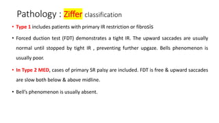 Pathology : Ziffer classification
• Type 1 includes patients with primary IR restriction or fibrosis
• Forced duction test (FDT) demonstrates a tight IR. The upward saccades are usually
normal until stopped by tight IR , preventing further upgaze. Bells phenomenon is
usually poor.
• In Type 2 MED, cases of primary SR palsy are included. FDT is free & upward saccades
are slow both below & above midline.
• Bell’s phenomenon is usually absent.
 