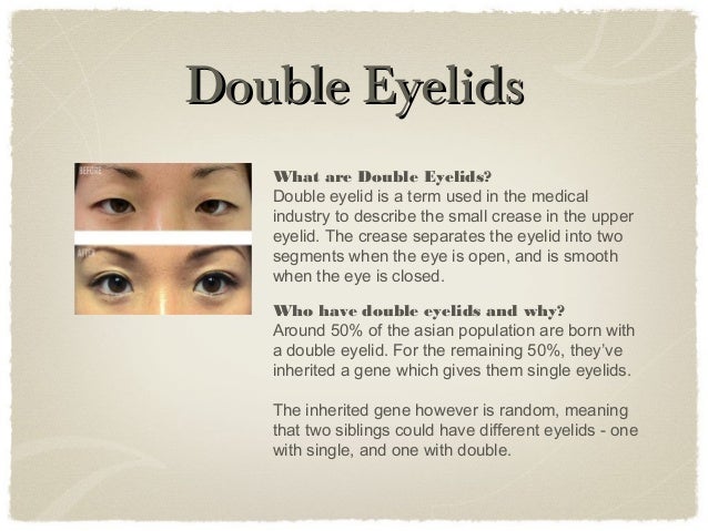 Double Eyelid Surgery Faq Asian Cosmetic Double Eyelid Surgery Faq Asian Cosmetic