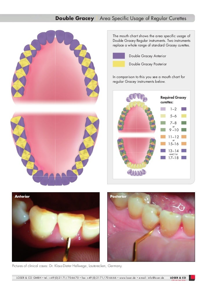 Double gracey curettes American Eagle instruments