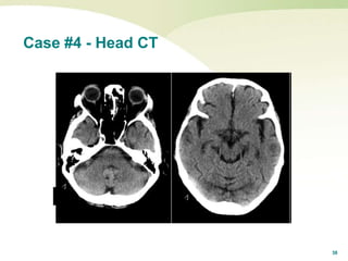 38
Case #4 - Head CT
 