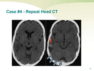 41
Case #4 - Repeat Head CT
 