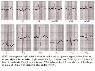 Double outlet right ventricle | PPTX