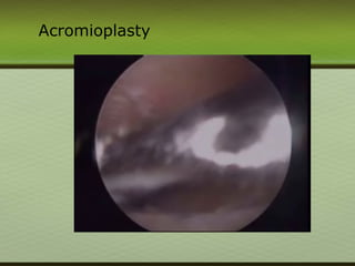 Acromioplasty
 