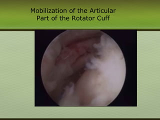 Mobilization of the Articular
Part of the Rotator Cuff
 
