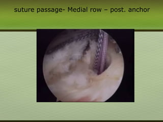 suture passage- Medial row – post. anchor
 