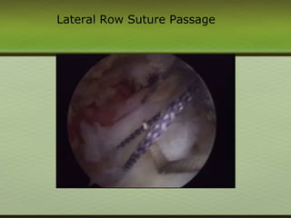 Lateral Row Suture Passage
 