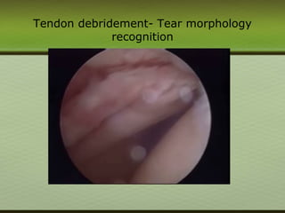 Tendon debridement- Tear morphology
recognition
 