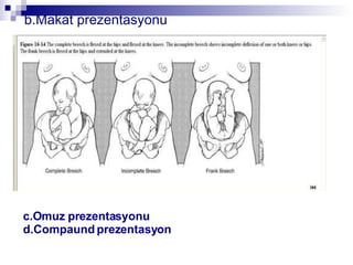 b.Makat prezentasyonu c.Omuz prezentasyonu d.Compaund prezentasyon 