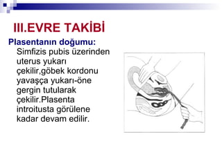 III.EVRE TAKİBİ Plasentanın doğumu:  Simfizis pubis üzerinden uterus yukarı çekilir,göbek kordonu yavaşça yukarı-öne gergin tutularak çekilir.Plasenta introitusta görülene kadar devam edilir. 