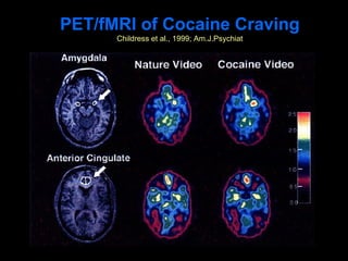 PET/fMRI of Cocaine Craving
      Childress et al., 1999; Am.J.Psychiat
 