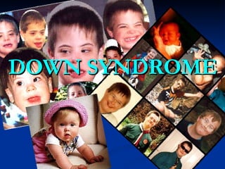 DOWN SYNDROME 