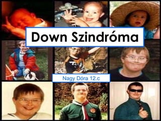 Down Szindróma
Click to edit Master subtitle style

                             Nagy Dóra 12.c
 