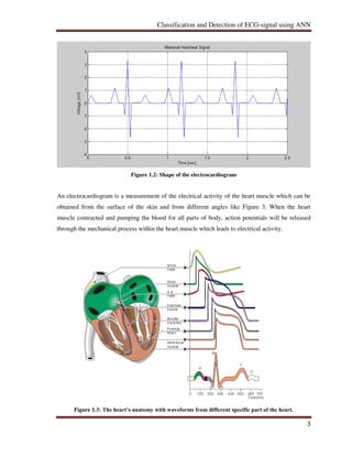 Classification and Detection of ECG-signals using Artificial Neural ...