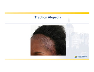 Traction  Alopecia
 