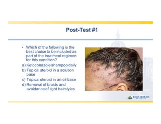 Post-­Test  #1
• Which  of  the  following  is  the  
best  choice  to  be  included  as  
part  of  the  treatment  regimen  
for  this  condition?
a) Ketoconazole  shampoo  daily
b) Topical  steroid  in  a  solution  
base
c) Topical  steroid  in  an  oil  base
d) Removal  of  braids  and  
avoidance  of  tight  hairstyles
 