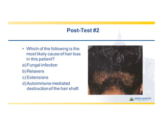 Post-­Test  #2
• Which  of  the  following  is  the  
most  likely  cause  of  hair  loss  
in  this  patient?  
a)Fungal  infection
b)Relaxers
c) Extensions
d)Autoimmune  mediated  
destruction  of  the  hair  shaft
 