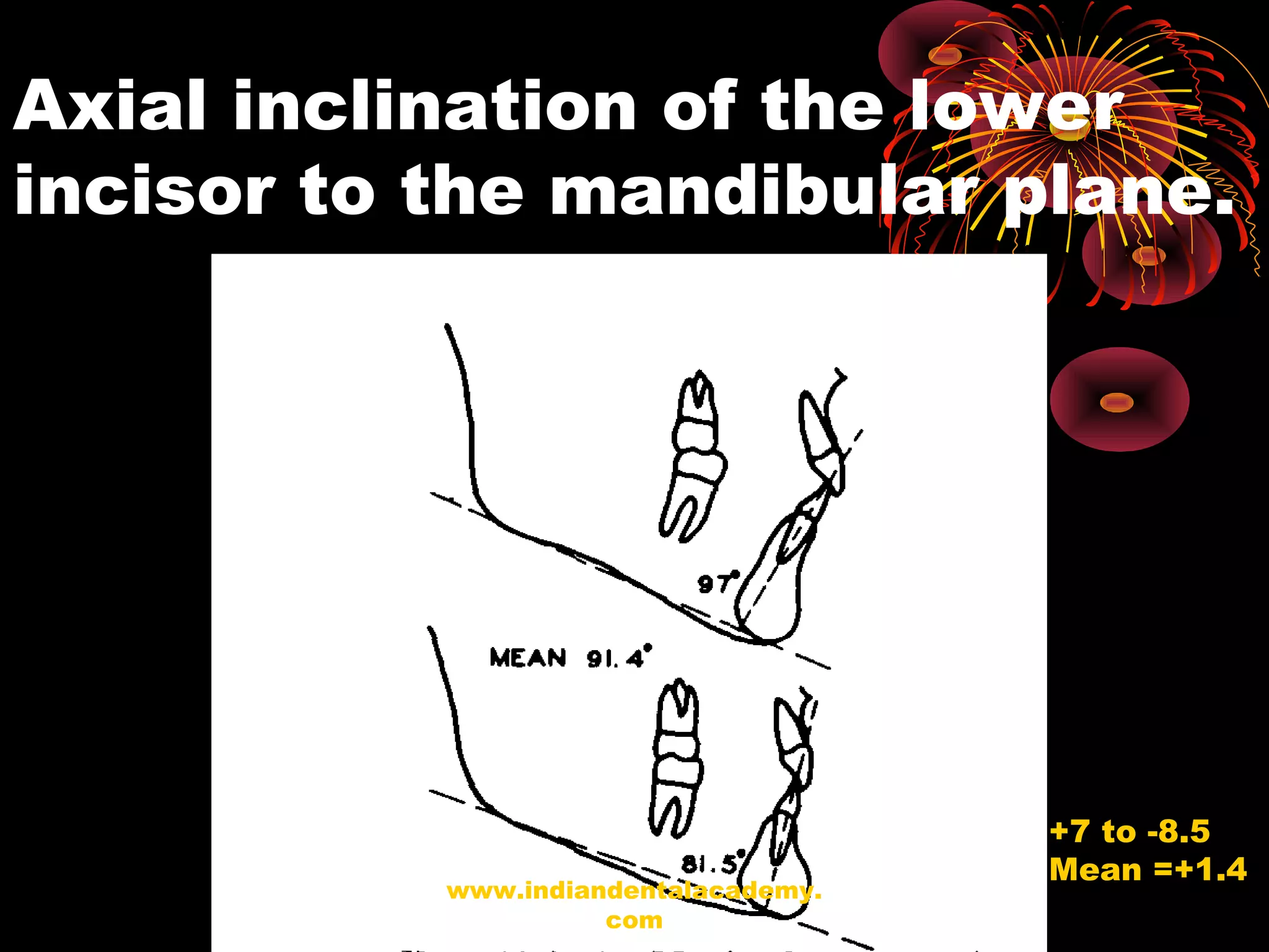 Axial inclination of the lower
incisor to the mandibular plane.
+7 to -8.5
Mean =+1.4
www.indiandentalacademy.
com
 