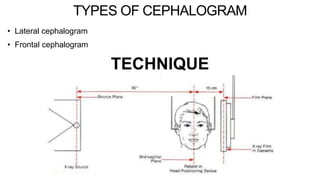 TYPES OF CEPHALOGRAM
• Lateral cephalogram
• Frontal cephalogram
TECHNIQUE
 