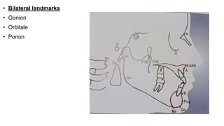 • Bilateral landmarks
• Gonion
• Orbitale
• Porion
 