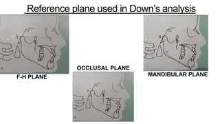 Reference plane used in Down’s analysis
F-H PLANE
OCCLUSAL PLANE
MANDIBULAR PLANE
 