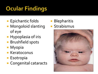  Epichantic folds
 Mongoloid slanting
of eye
 Hypoplasia of iris
 Brushfield spots
 Myopia
 Keratoconus
 Esotropia
 Congenital cataracts
 Blepharitis
 Strabismus
 