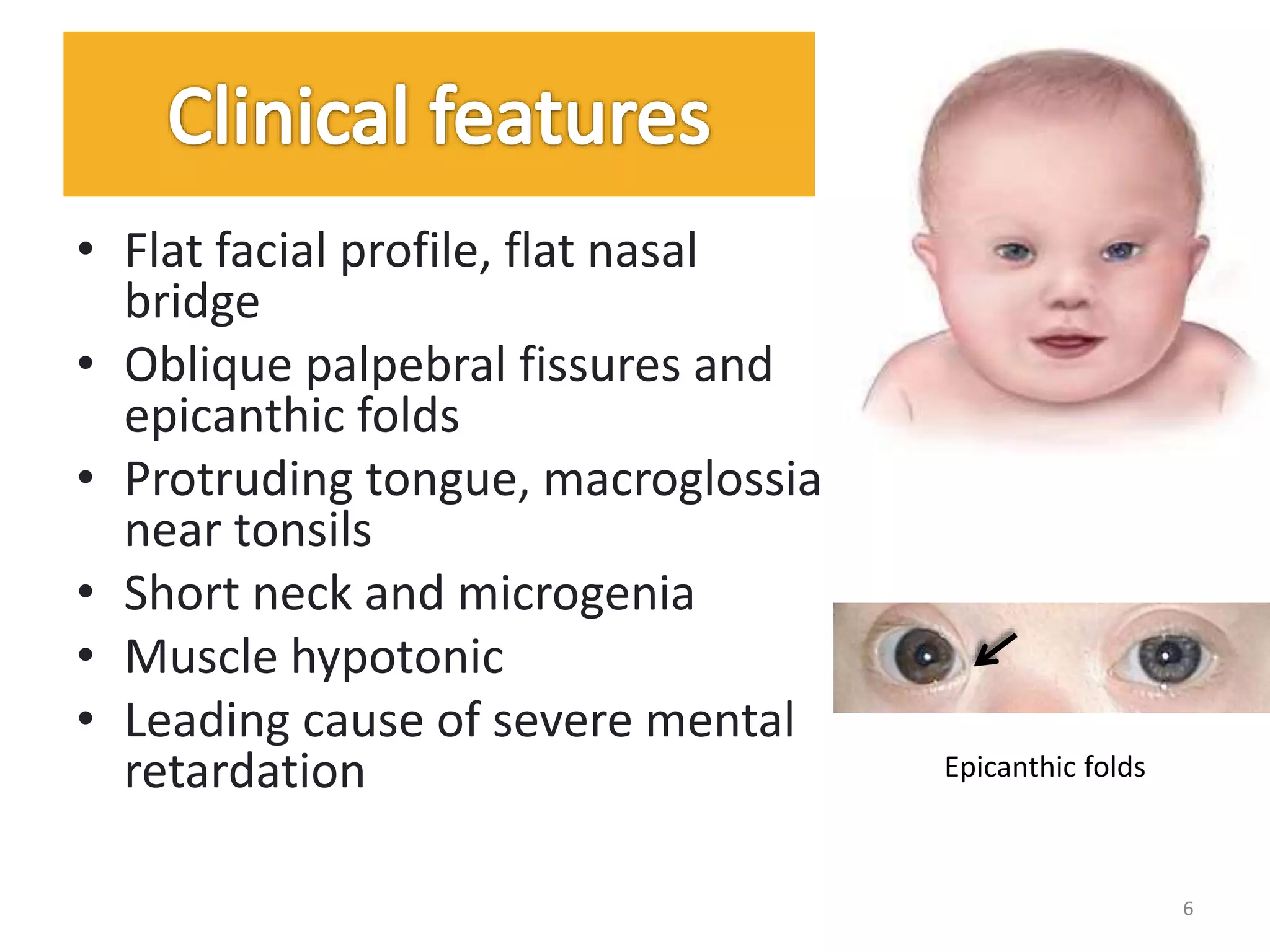 • Flat facial profile, flat nasal
bridge
• Oblique palpebral fissures and
epicanthic folds
• Protruding tongue, macroglossia
near tonsils
• Short neck and microgenia
• Muscle hypotonic
• Leading cause of severe mental
retardation Epicanthic folds
6
 