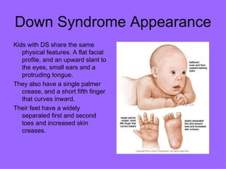 Down Syndrome Appearance  Kids with DS share the same physical features. A flat facial profile, and an upward slant to the eyes, small ears and a protruding tongue.  They also have a single palmer crease, and a short fifth finger that curves inward. Their feet have a widely separated first and second toes and increased skin creases.  