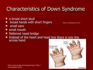 Characteristics of Down Syndrome  a broad short skull broad hands with short fingers  ( http:// ic.galegroup.com ) small ears small mouth flattened nasal bridge  Instead of the heart and head line there is one line across hand ( http:// www.google.com/imgres?imgurl =http:// www.glogster.com / ) 